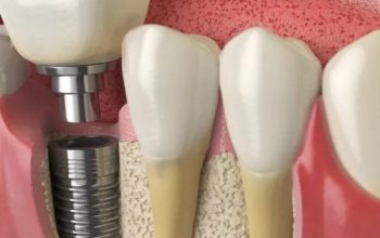 Why do patients need dental implants?