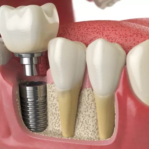 Why do patients need dental implants?
